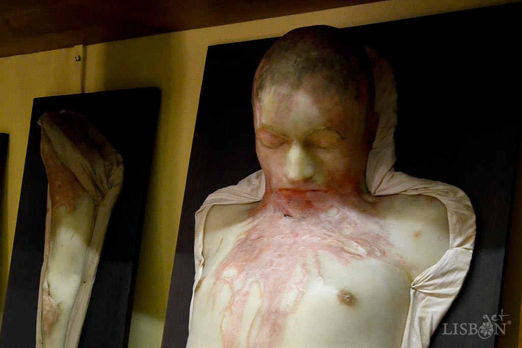 Wax model of the Dermatology Collection of the Capuchos Hospital